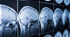 Brain injury treatment in Tampa